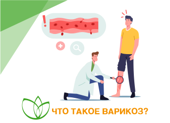 Что такое варикоз?