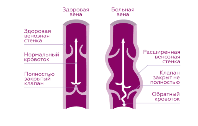 Виды компрессионного трикотажа